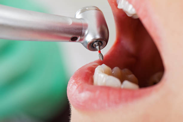 Best Emergency Tooth Extraction in Pendergrass, GA